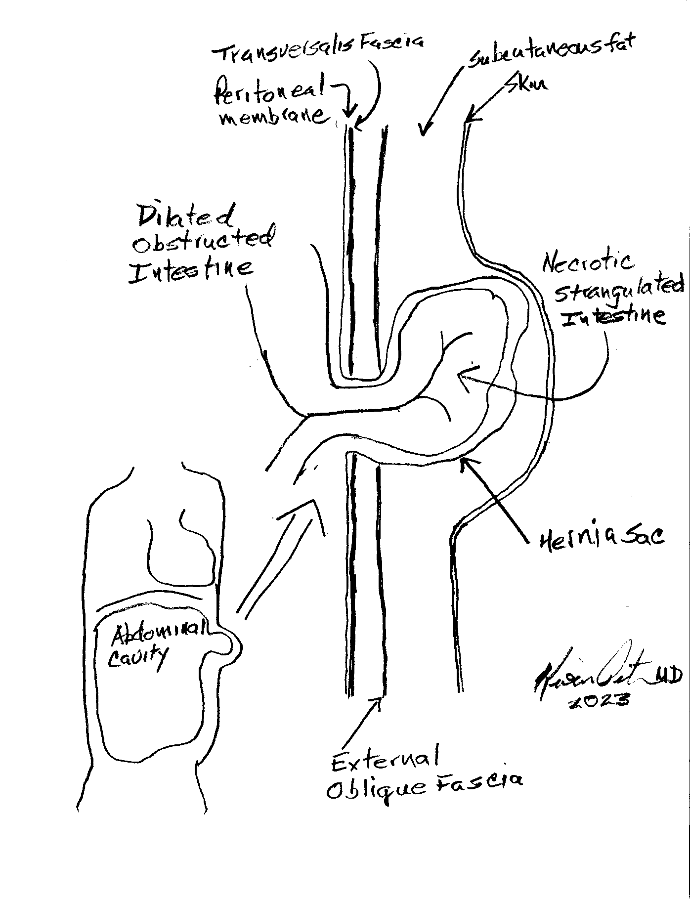 diagram of strangulated hernia